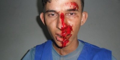 Vilhena - Cachorro solto na rua faz mais uma vítima em Vilhena: rapaz tem face lacerada