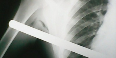 Rolim de Moura – Criança tem barra de ferro transfixada no corpo