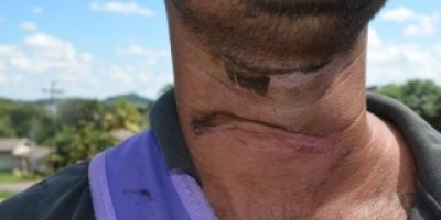 Santa Luzia: Motociclista atingido por fio telefônico tem pescoço lesionado