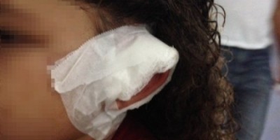 Jaru - Criança tem parte do couro cabeludo arrancado em acidente em parque de diversão 