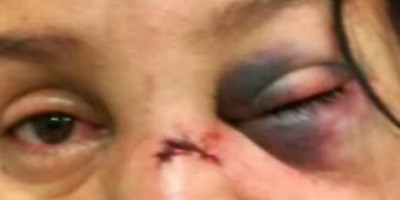 Ouro Preto - Mulher tem o rosto deformado por golpes de capacete desferidos pelo amásio