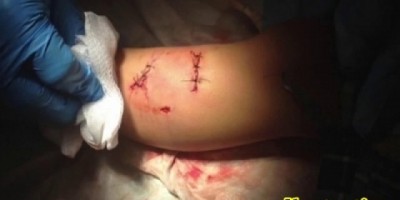 Garoto de 10 anos tem o pênis arrancado a mordidas por cachorro em Itapuã do Oeste