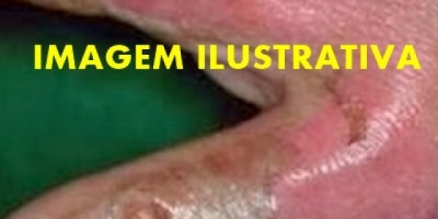 Homem de 70 anos morre após atear fogo ao próprio corpo na cidade de Cerejeiras 