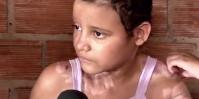 Rolim de Moura -  Reportagem - Menina que foi vítima de grave queimadura precisa de ajuda para continuar o tratamento
