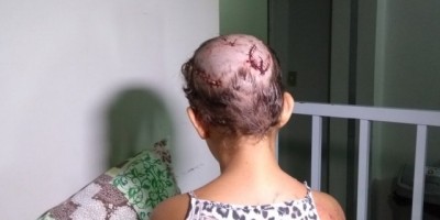 Menina de 10 anos leva mais de 30 pontos na cabeça após ser atacada por pit bull em Vilhena