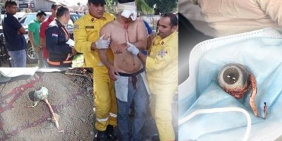 Brasileiro arranca o próprio olho no Paraguai