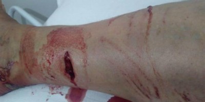 Mulher é atacada por porcões do mato ao fazer caminhada em seu sítio, em Pimenta Bueno