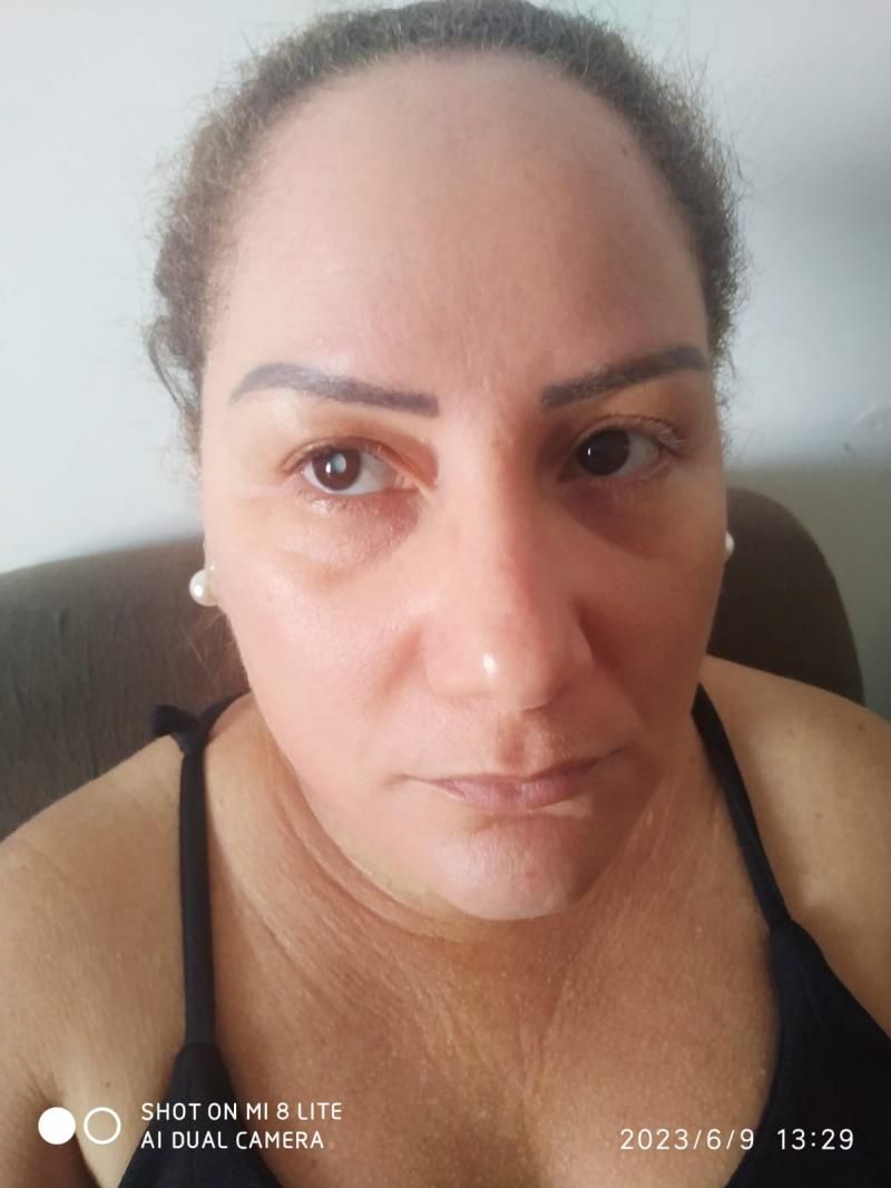 Ex-moradora de Rolim de Moura busca apoio para cirurgia de catarata e evitar perda total da visão Ex-moradora de Rolim de Moura busca apoio para cirurgia de catarata e evitar perda total da visão