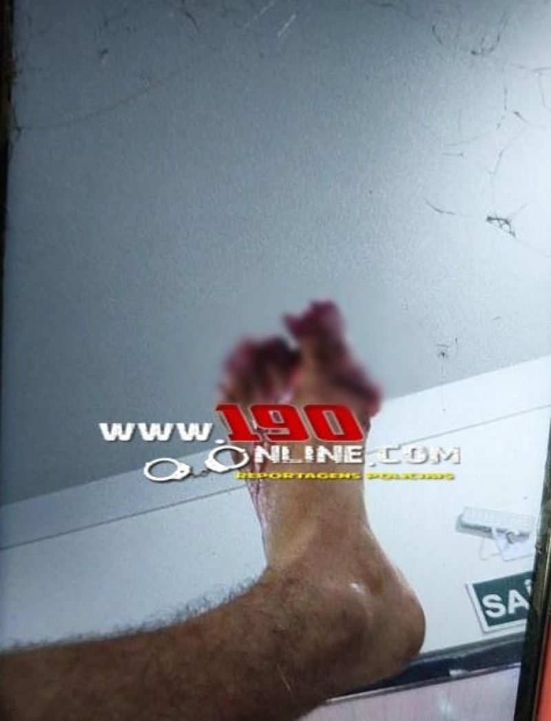 Homem perdeu partes dos dedos dos pés em acidente de trânsito, em Alta Floresta do Oeste Homem perdeu partes dos dedos dos pés em acidente de trânsito, em Alta Floresta do Oeste